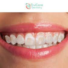 Post-Braces Stains On Teeth: Cause And Treatment – Trucare Dentistry Roswell