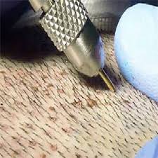 Finding The Best Place For Comprehensive Hair Care Centre In Chandigarh At Kesh Clinic Hair Transplant In India Hair Transplant Equipment