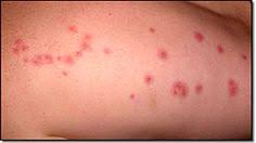 Bug Bites That Look Like Mosquito Bites But Aren T Insect Bite Identification Guide To Make Identifying Insect Bites Easy Wife And Mom In Training Insect Bites Identifying Insect Bites Insect Bite Identif