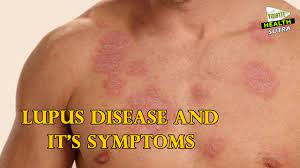 And can be associated with various systemic disorders (e.g., systemic lupus erythematosus) and several forms of systemic vasculitis. Lupus Disease And It S Symptoms Health Sutra Youtube