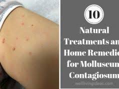 10 Natural Treatments And Home Remedies For Molluscum Contagiosum Natural Treatments Home Remedies Remedies