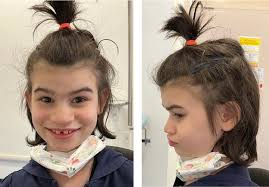 Frontal and lateral view of our patient at age 14 6/12 years. [Colour...