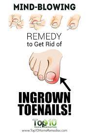 Home Remedies For Ingrown Toenails Top 10 Home Remedies Ingrown Toe Nail Remedies Toe Nails