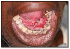 Squamous cell cancer (scc) affects one of three kinds of cells composing the epidermis. The Clinical Characteristics Of Oral Squamous Cell Carcinoma In Patients Attending The Medunsa Oral Health Centre South Africa