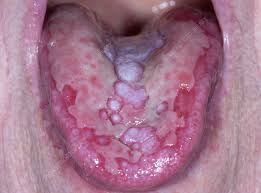 Image result for lichen planus on tongue)