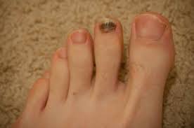 Often though there will be other. How To Manage Black Toenails Naturally Nail Diseases And Disorders Stiff Knee Toe Nails