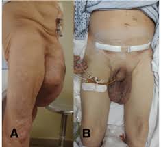 Image result for Inguinal hernia man