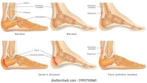 Image result for Calcaneal Apophysitis
