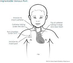 Implantable Venous Port Catheter Port Childrens Hospital