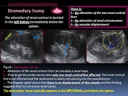 Few animals are more useful to mankind than the camel and the dromedary. Key Points To Differentiate Renal Pseudotumors Ppt Video Online Download