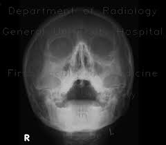 Image result for Sinus X Ray