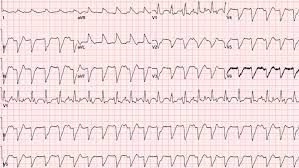 Myocarditis can affect your heart muscle and your heart's electrical system, reducing your heart's ability to pump and causing rapid or abnormal heart rhythms (arrhythmias). Cureus Acute Myocarditis Presenting As Acute Coronary Syndrome