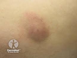 Image result for Panniculitis