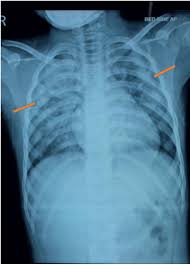 Image result for Pulmonary Contusion
