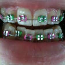 Hot pink and lime green braces. 28 Braces Ideas Braces Braces Colors Cute Braces