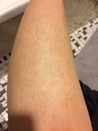 We have all the information you need about public and private beauty salons that provide laser hair removal worldwide. Will My Red Dots Go Away After A Few More Sessions Of Laser Hair Removal Photo