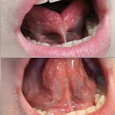 Image result for Ankyloglossia