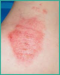 Image result for Atopic eczema atopic dermatitis
