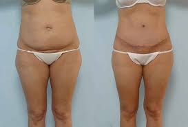 Pin On Liposuction Before And After