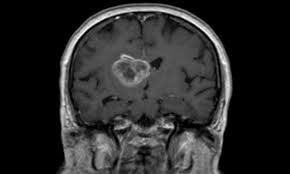 malignant brain tumors the ct findings after interstitial radiation therapy for brain tumors have not been extensively described. New Actively Personalized Therapeutic Vaccine For Brain Cancer Healthcare In Europe Com