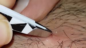 When accompanied by an infection of the hair follicles, the condition is known as folliculitis. Plucking Infected Hair Follicle Youtube