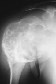 Image result for Chondrosarcoma