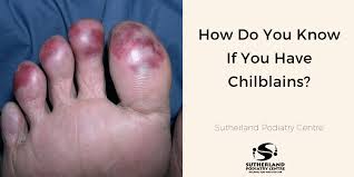 Image result for Chilblains