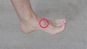 A person with a bone spur on their foot may notice Saddle Bone Deformity Fix Flat Feet
