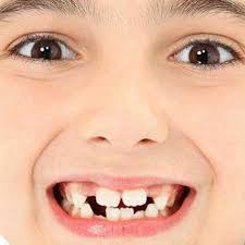 Pigeon botol susu bayi pp 50 ml (air. Kesehatan Anak Kerusakan Gigi Karena Botol Susu Sehatfresh Com