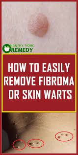Simple Hacks Tricks How To Easily Remove Fibroma And Skin Warts Healthy Home Remedy Warts Remedy Facial Warts Warts On Face