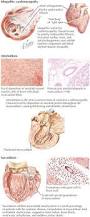 Image result for Restrictive Cardiomyopathy