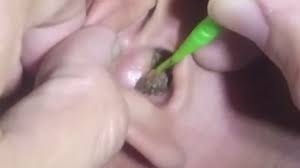 Hence, it is important that you clean your ears periodically in a safe and effective manner. Stubborn Earwax Finally Removed With Hydrogen Peroxide Application Youtube