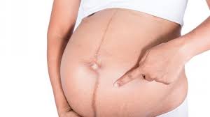 Check spelling or type a new query. Linea Nigra Pada Ibu Hamil Bisa Prediksi Jenis Kelamin Bayi