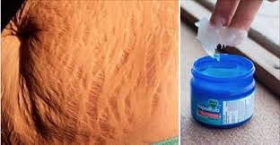 Utilize Vick Vaporub Desta Forma E A Melhor Maneira De Combater Estrias Celulite E Fungo Nas Unhas Cura Pela Natureza Vick Vaporub Fungos Nas Unhas Celulite