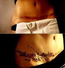 When Can You Have A Tummy Tuck After C Section Pin On Tummy Tuck Scar Tattoo