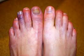 Image result for Chilblains