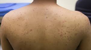 Image result for folliculitis symptoms