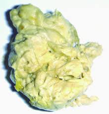 Image result for acholic stools human