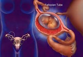 Kehamilan ektopik adalah saat kehamilan tumbuh di luar rahim anda, biasanya di tuba falopi anda. Kehamilan Mengandung Luar Rahim Ectopic Pregnancy A Wife And A Mummy To Be