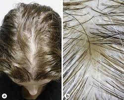 * first of all it strongly decreases cortisol and aldosterone and increases dhea levels. A Clinical Picture Of Female Pattern Hair Loss B Dermoscopy Showing Download Scientific Diagram