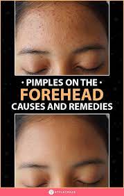 Levels of exfoliation · dermatologist tested · plastic microbead free How To Get Rid Of Pimples On Forehead Forehead Acne Cause Pimples On Forehead Pimples On Face
