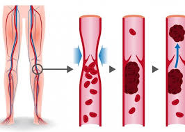 Deep vein thrombosis (dvt) is the formation of a blood clot in a deep vein, most commonly in the legs or pelvis. Soorten Trombose Trombosestichting