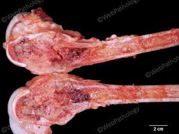 Image result for Osteosarcoma