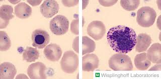 The peripheral blood smear demonstrates hypochromic, microcytic red blood cells, thin elliptocytes, anisopoikilocytosis, and decreased reticulocytes (figure 1 . Anemia Knowledge Amboss