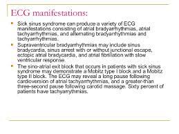Sick Sinus Syndrome