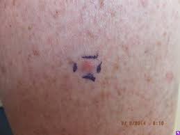 Learn the facts to worry less and make good health decisions. Disease Management Nonmelanoma Skin Cancer