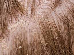 Discomfort from a fungal infection. Psoriasis Or Dandruff Symptoms Treatment And Tips