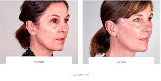 Pictures of hairstyles for sagging jowls, this can be an expensive habit. How To Get Rid Of Jowls The Cosmetic Skin Clinic