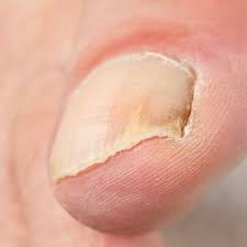 Vicks vapor rub is a great treatment for toenail fungus. Getting Rid Of Toenail Fungus Thriftyfun
