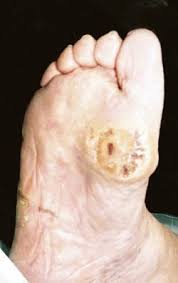 En sår hals refererer til smerte, kløe eller irritabilitet i halsen. Diabetiske Fotsar Tidsskrift For Den Norske Legeforening